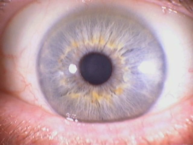 Iridology eys 6