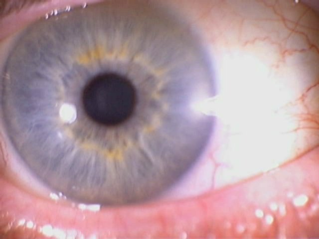 Iridology eys 8