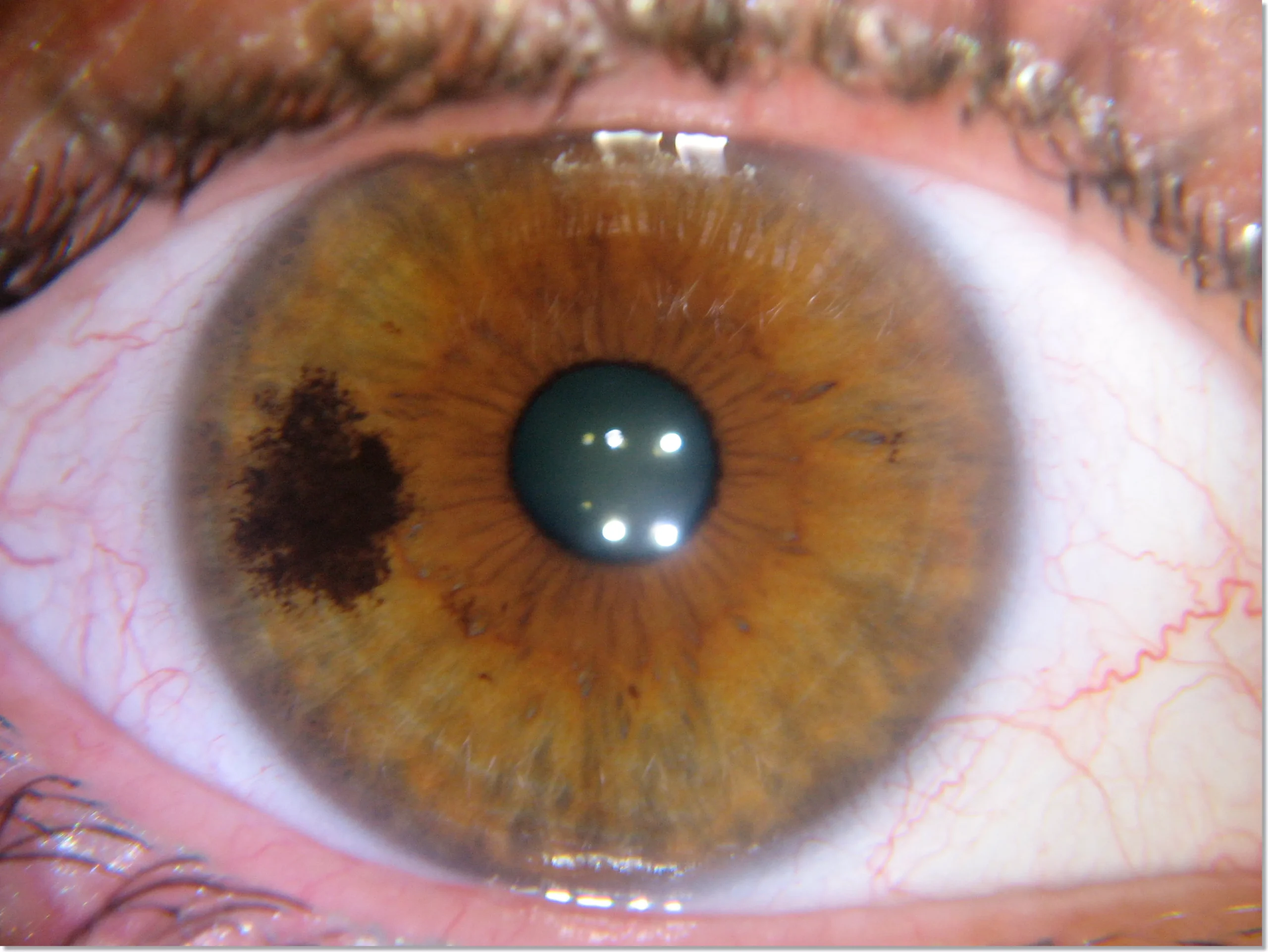 How to Take Photos of Eye for Iridology?