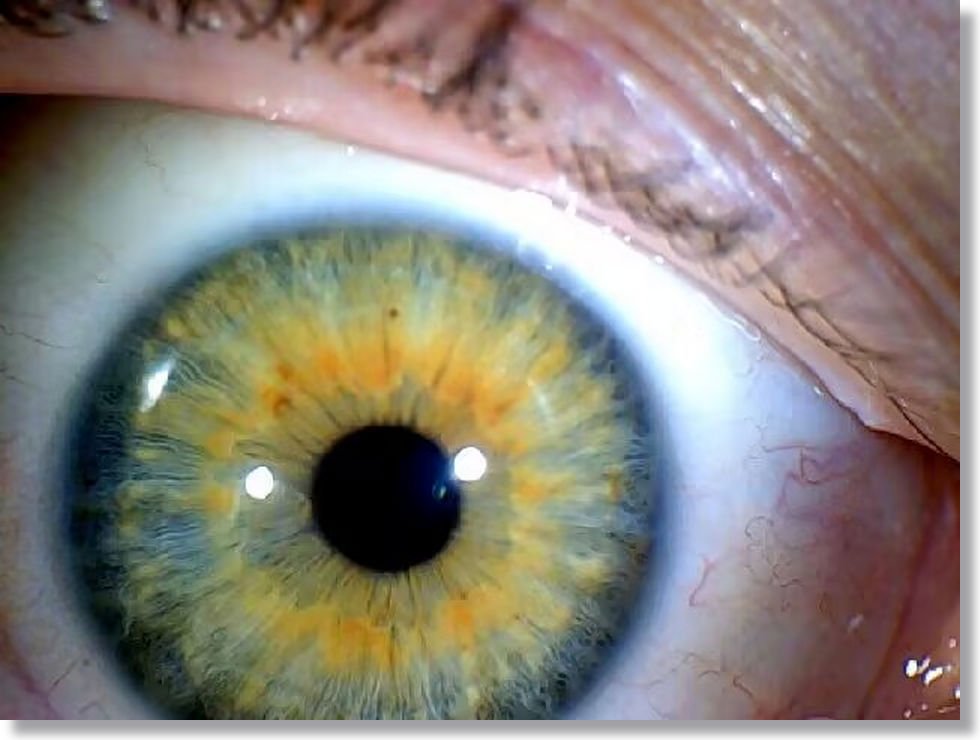 Iridology Color Analysis