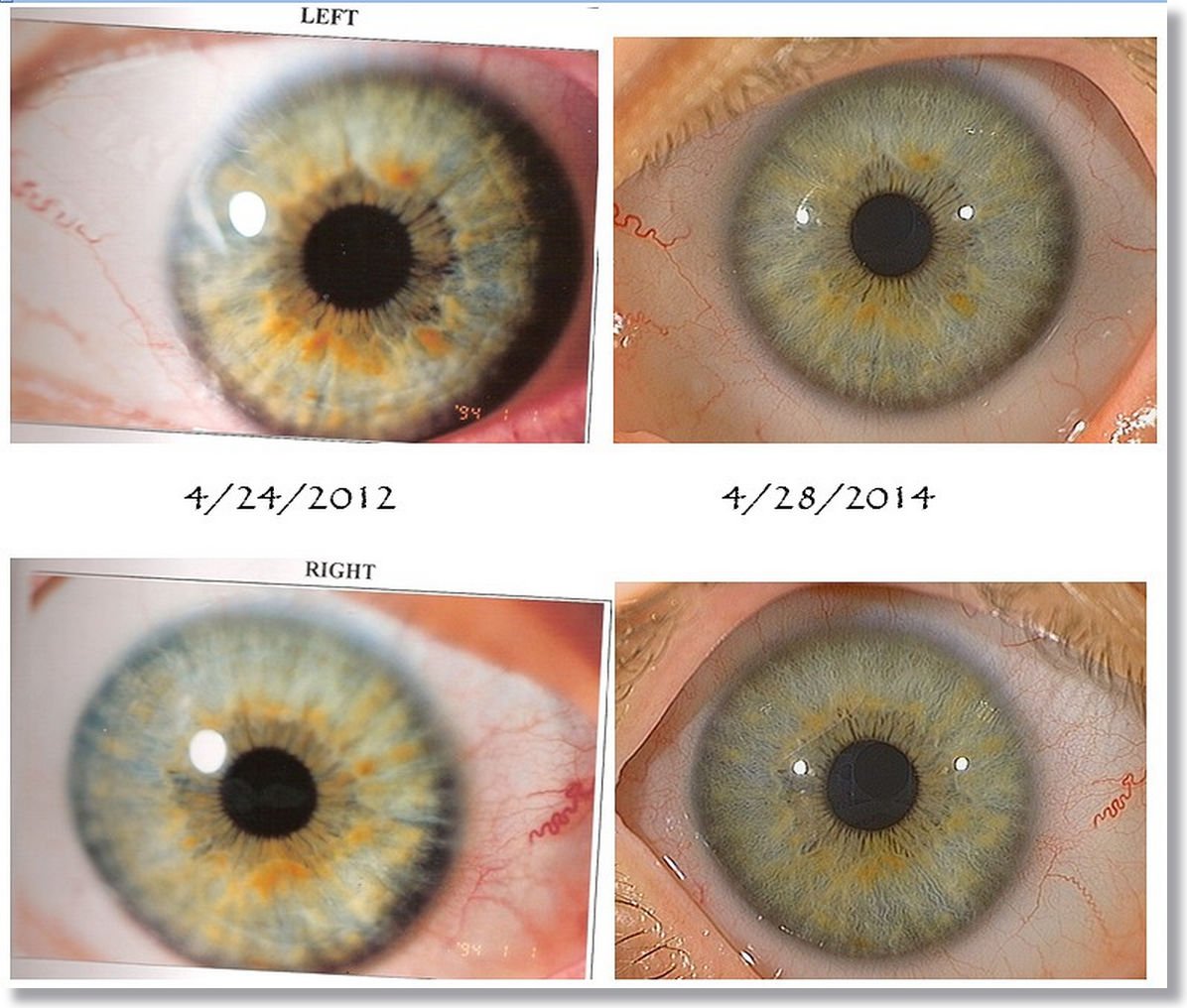 Iridology Color Analysis